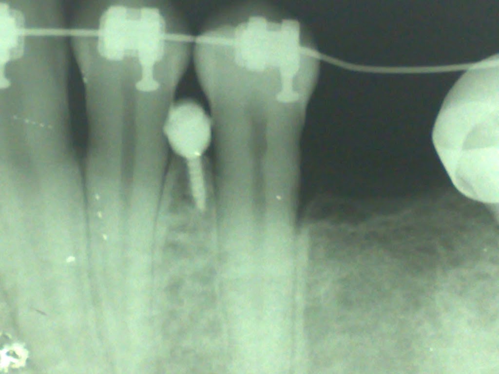 CONTROVERSIA I  – Mini-implantes e Ancoragem Absoluta: Exemplo trasdisciplinar para uma Ortodontia Moderna.