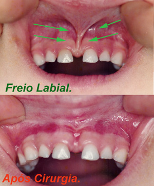 Leia mais sobre o artigo Pergunte ao Ortodontista! – O que é Frenectomia?