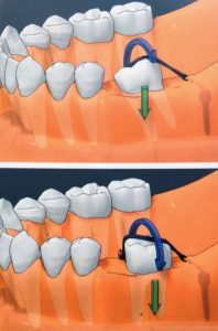 Leia mais sobre o artigo #1 – Pequenos Movimentos utilizando Mini-implante: Verticalização de um único molar: