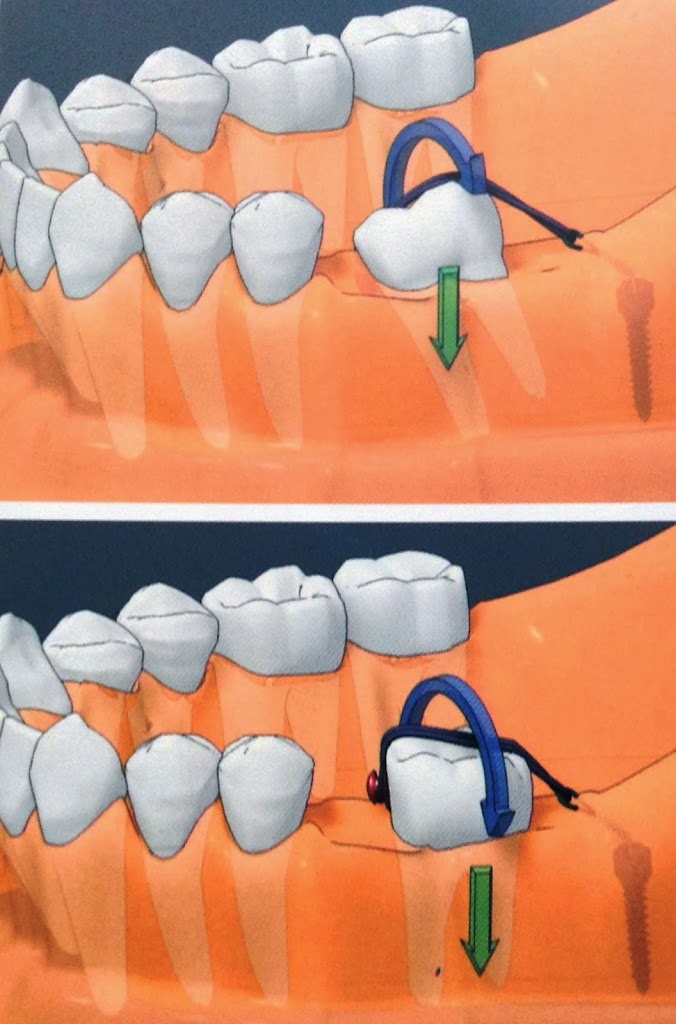 Você está visualizando atualmente #1 – Pequenos Movimentos utilizando Mini-implante: Verticalização de um único molar: