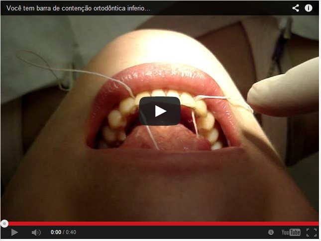 Leia mais sobre o artigo Como passar fio-dental usando contenção inferior fixa.