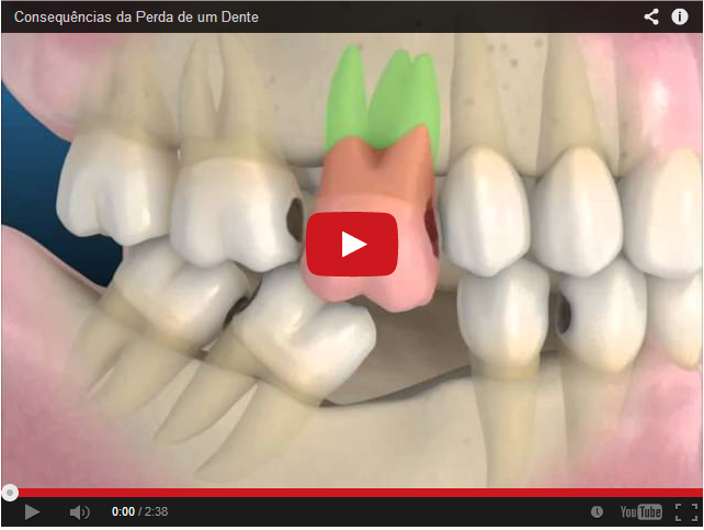 Leia mais sobre o artigo Extraordinário! Veja o que pode acontecer quando se perde um dente!