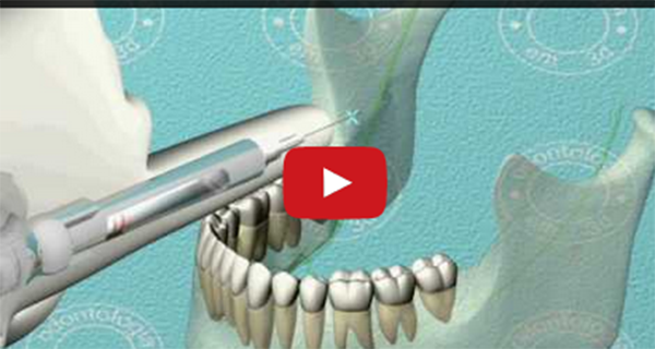 Leia mais sobre o artigo Anestesia Pterigomandibular – 3D