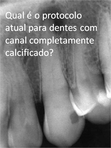 Você está visualizando atualmente “Qual é o protocolo atual para dentes com canal completamente calcificado?”