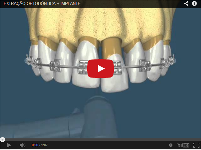 Leia mais sobre o artigo Veja essa! Excelente vídeo três em um: Ortodontia, Extração e Implante!