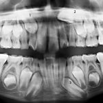 Radiographie-canine-incluse-FrTre13022006P-Orthodontiste-Chamberland-Québec