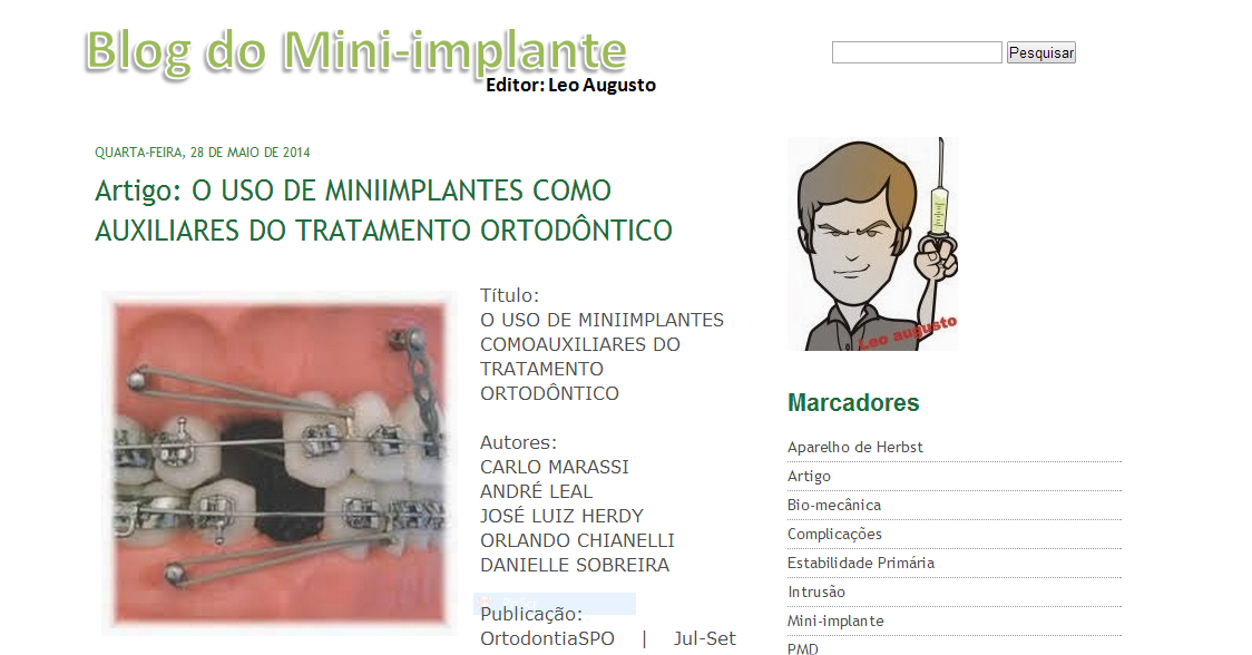 Você está visualizando atualmente Blog do Mini-implante, você tem que conhecer!