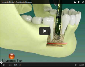 Leia mais sobre o artigo Veja a Sequência  C O R R E T A  de uma Cirúrgica de Implante Dental