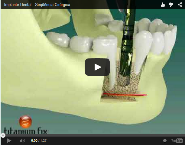 Veja a Sequência  C O R R E T A  de uma Cirúrgica de Implante Dental