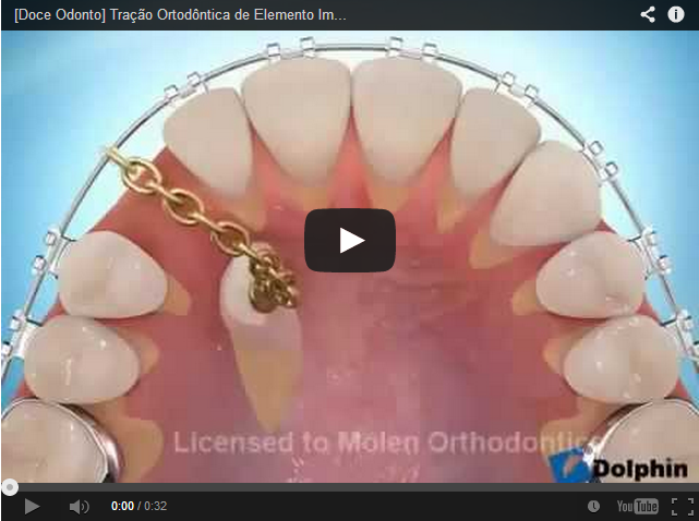 Vídeo ilustrativo de um tracionamento de um elemento dental impactado.