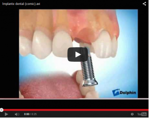 Leia mais sobre o artigo S E N S A C I O N A L  Vídeo de um Implante Dentário. Veja!