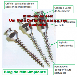 Leia mais sobre o artigo Mini-implantes: Um Guia Definitivo para o seu paciente!