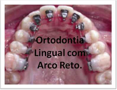 Você está visualizando atualmente Veja: Ortodontia Lingual com Arco Reto!