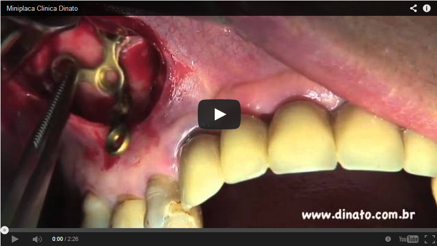 Leia mais sobre o artigo Grande NOVIDADE  da Ortodontia Mundial: Miniplacas!