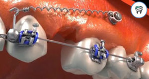 Leia mais sobre o artigo Mini-implantes: Retração Anterior – GUIA DEFINITIVO