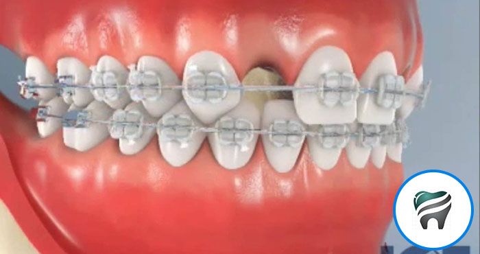 Leia mais sobre o artigo Um Vídeo PERFEITO! Colocação de Implante dental pós uso de aparelho