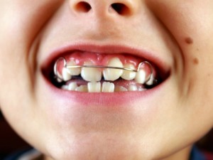 crianca-sorrindo-e-mostrando-o-aparelho-ortodontico-preso-aos-dentes-foto-nessli-orpmasshutterstockcom-0000000000011A4C