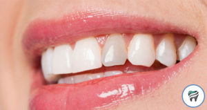 Leia mais sobre o artigo Sabe aquele dente escuro? Tem jeito de clarear!