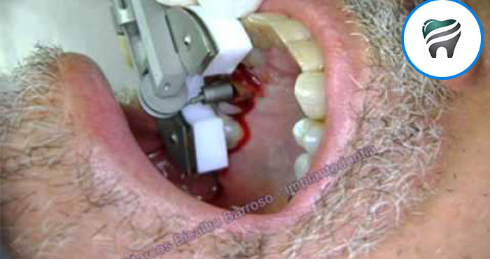 Leia mais sobre o artigo Veja que FANTÁSTICA é técnica de Extração Dentária Minimamente Traumática – Você nem vai acreditar!