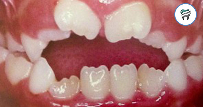 Leia mais sobre o artigo Mordida Aberta Dentária X Mordida Aberta Esquelética