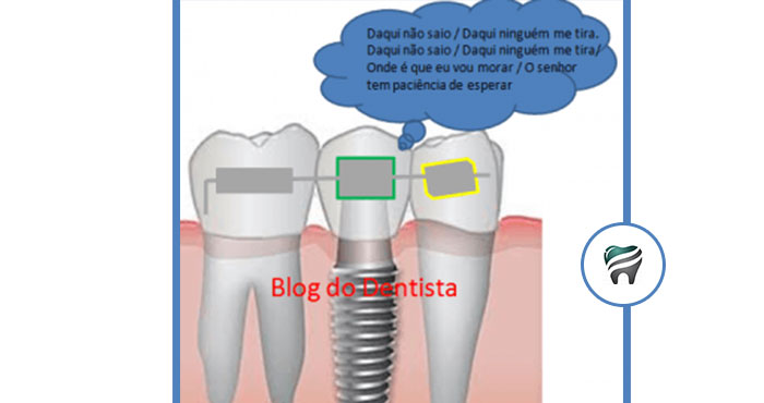 Leia mais sobre o artigo Pergunte ao Ortodontista: “Tenho 2 implantes, posso usar aparelho?”