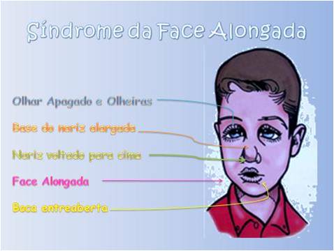 Sindrome da face alongada