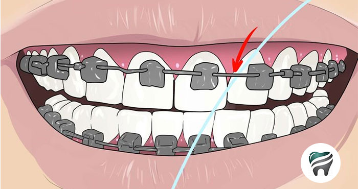 Usando Fio dental, C O R R E T A M E N T E, com  Aparelho Fixo – 5 passos