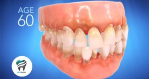 Leia mais sobre o artigo [VÍDEO] Como dentes desalinhados podem comprometer a sua saúde.