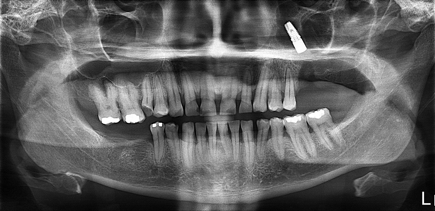 Você está visualizando atualmente Deslocamento de implante dentário para o seio maxilar: O QUE FAZER — COM VÍDEO