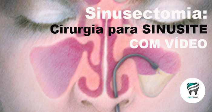 Você está visualizando atualmente FIQUE POR DENTRO — Sinusectomia: Cirurgia para sinusite – COM VÍDEO