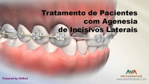 tmp_cover_Missing Lateral Incisor - Treatment Options - Orthodontic & Restorative Treatment_CDB77143