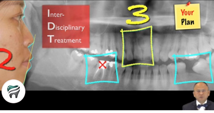 Leia mais sobre o artigo Relato de um FANTÁSTICO caso clínico, realizado com tratamento interdisciplinar (ortodontia + implante)