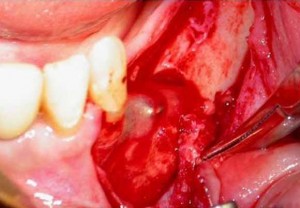 hemorragia-bucal-dental-dentaria (1)