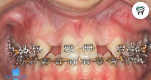 Leia mais sobre o artigo AGENESIA INCISIVOS LATERAIS SUPERIORES – O grande DESAFIO para a implantodontia.