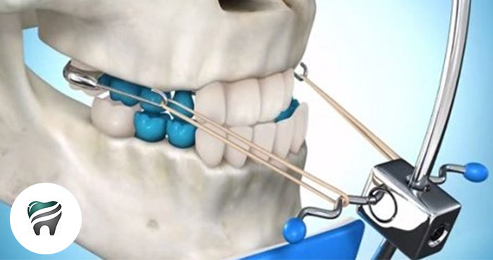 A MÁSCARA — Tratamento ortodôntico: Classe III por deficiência de maxila – Tração Reversa de maxila
