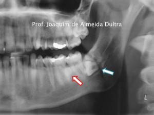 Osteoma em corpo mandbular3