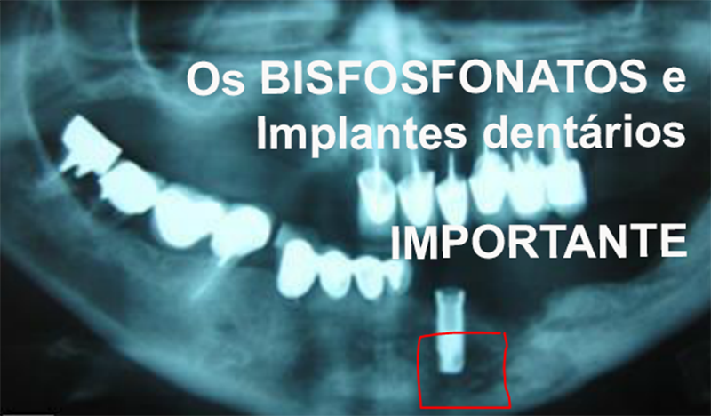 Você está visualizando atualmente Os BISFOSFONATOS e implantes dentários – ULTRA IMPORTANTE