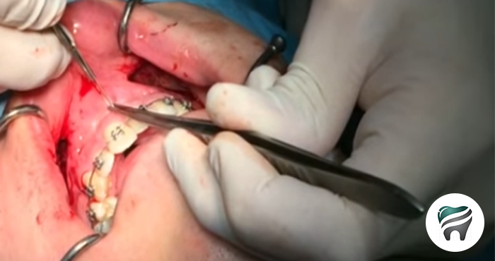 Você está visualizando atualmente Expansão rápida da maxila cirurgicamente assistida – CENAS FORTES
