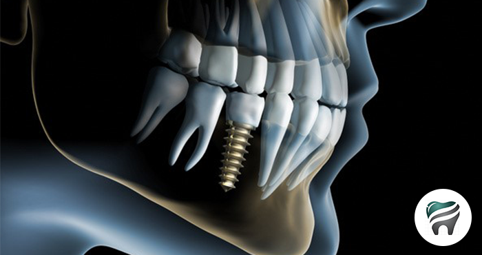 Leia mais sobre o artigo 3 Técnicas de como Higienizar os Implantes Dentários – EXCELENTE VÍDEO