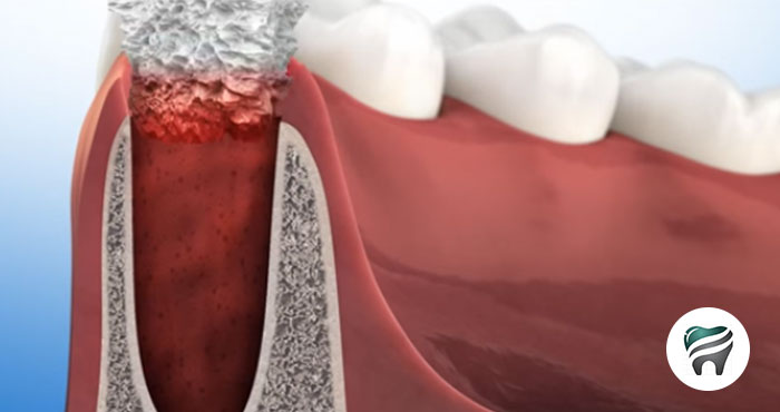 Preservação óssea após extração dentária, com BIOMATERIAIS – QUAL A SUA OPINIÃO?