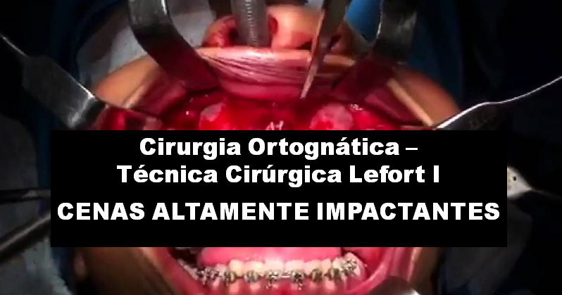 Você está visualizando atualmente Cirurgia Ortognática – Técnica cirúrgica Lefort I – CENAS ALTAMENTE IMPACTANTES