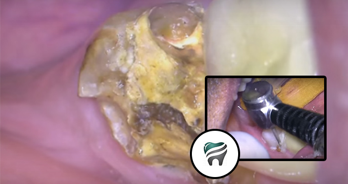 VÍDEO SUPER TOP — Reconstrução do dente para tratamento canal