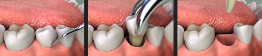 Procedure-Removing-A-Tooth-Extration-Houston-Dentist