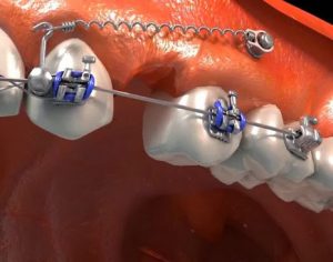 Mini_implantes_ortodonticos_1 (1)