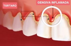 gingivitis1-500x3251