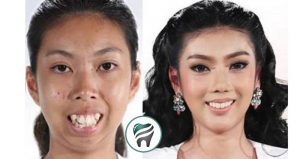 Leia mais sobre o artigo Uma Tailandesa, que nasceu sem queixo e com dentes para frente, se transforma! — VEJA O CASO
