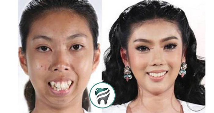 Você está visualizando atualmente Uma Tailandesa, que nasceu sem queixo e com dentes para frente, se transforma! — VEJA O CASO