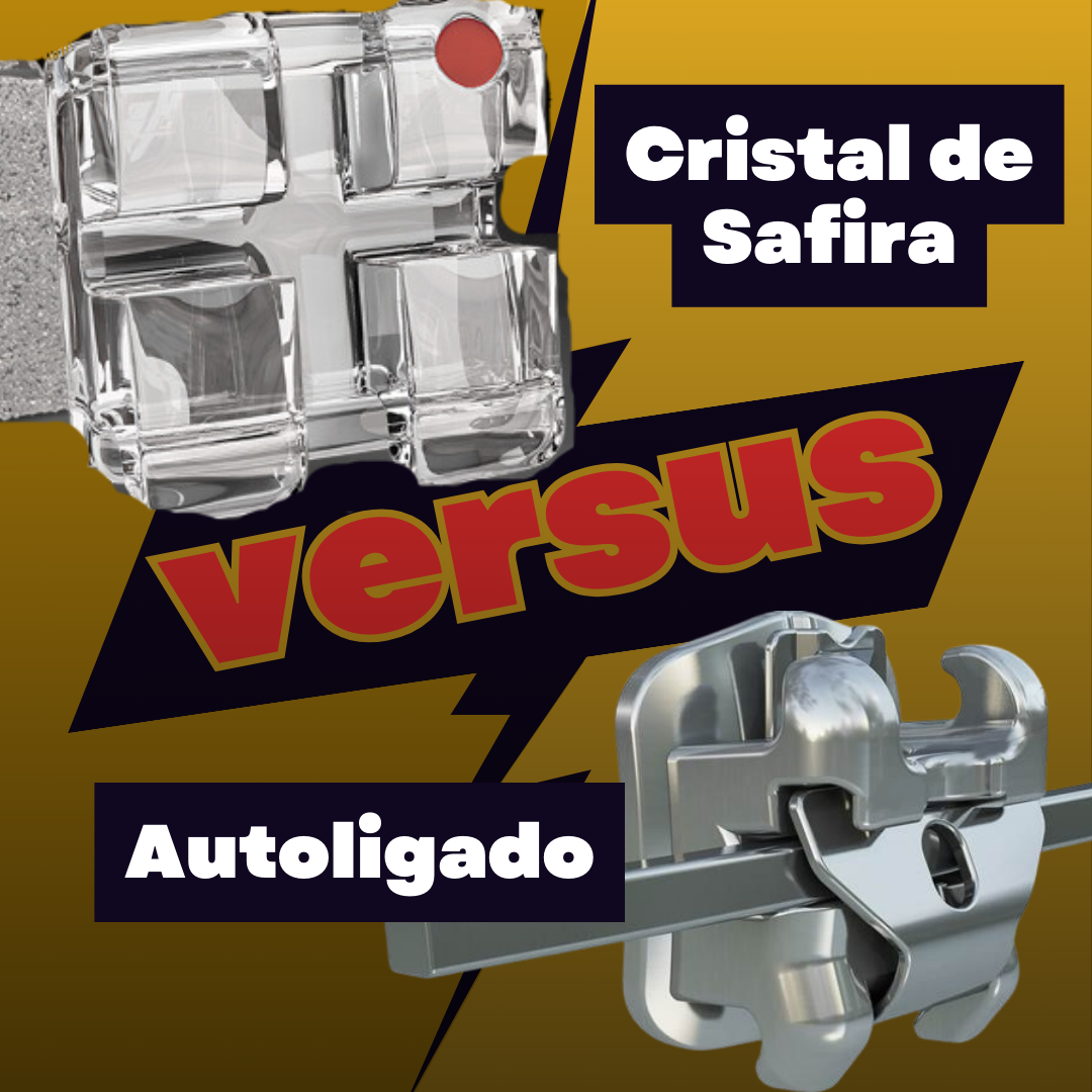 ⚡⚡ Braquetes de Cristal de Safira  vs. Braquetes Autoligados:  Estética, Eficiência e Conforto